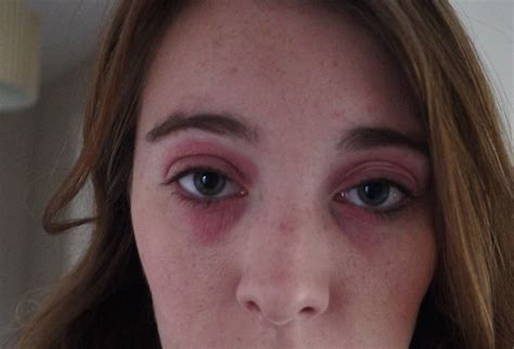 Allergic Reaction To Makeup Under Eyes - Mugeek Vidalondon