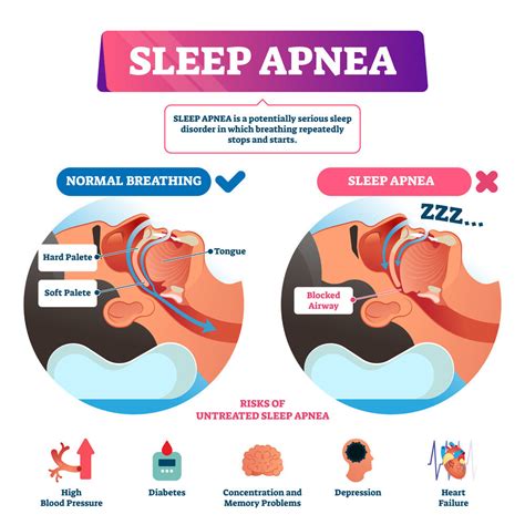 A Guide To Living With Sleep Apnoea - A Class Blogs