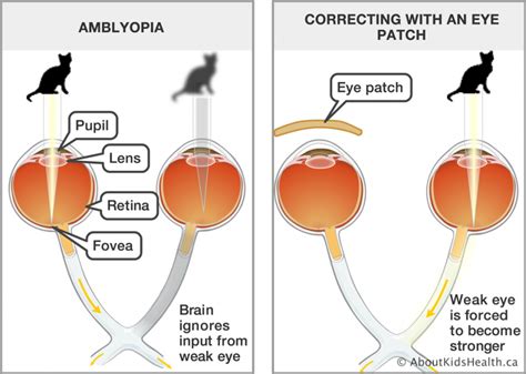 How to fix Lazy eye (Amblyopia)? - Evershine Optical