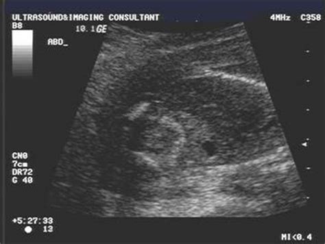 Echogenic Bowel; Hyperechogenic Bowel