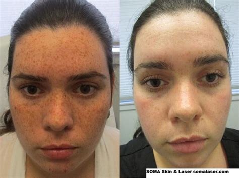 Revlite Laser For Freckles and Brown Spots in NJ | SOMA Skin & Laser