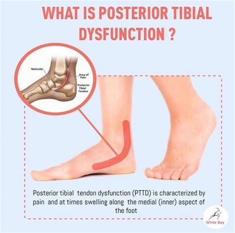 Pain in the inner part of the Ankle? Posterior Tibial Tendon Dysfunction