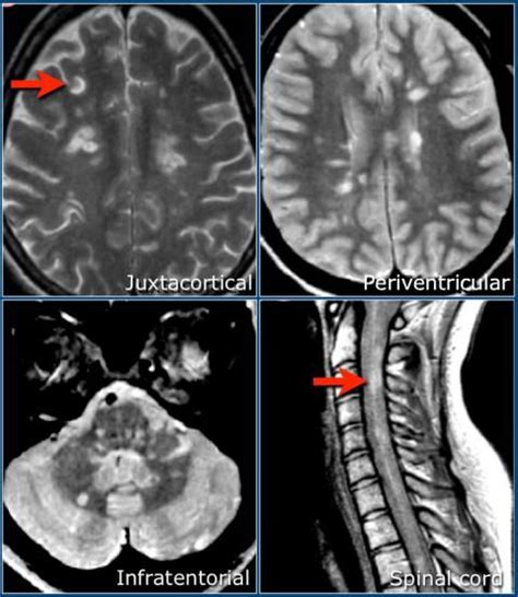 The Radiology Assistant : Diagnosis and differential diagnosis in 2020 | Multiple sclerosis ...