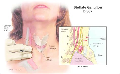 Stellate Ganglion Block - iSPINE