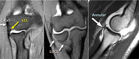 The Radiology Assistant : Elbow - MRI