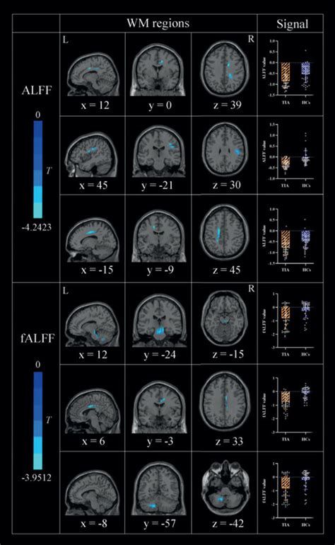 Regions of WM showing group differences in ALFF and fALFF together with ...