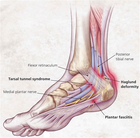 Heel pain causes, symptoms, diagnosis, pain relief & heel pain treatment