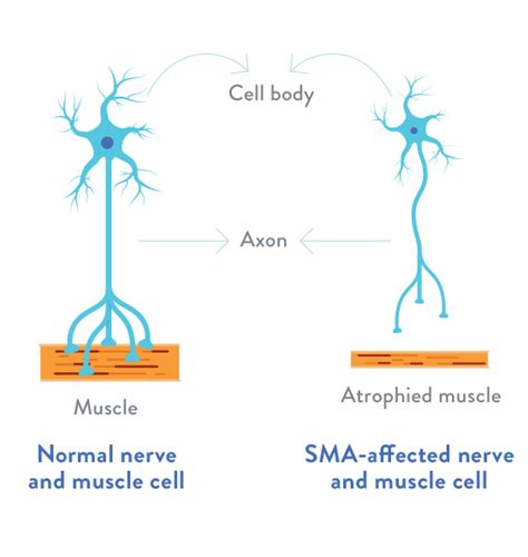 What is SMA (Spinal Muscular Atrophy)? | SMN1 & SMN2 Genes | Spinal ...