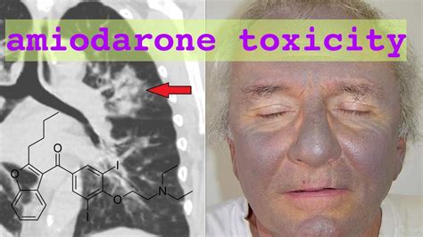 amiodarone toxicity - YouTube