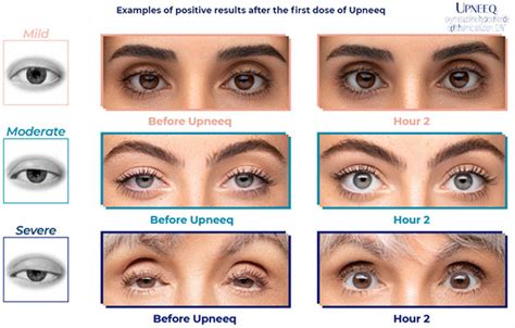 Droopy Eyelids Getting in the Way? | Vision Care Associates