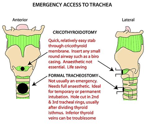 Tracheostomy Vs Cricothyrotomy