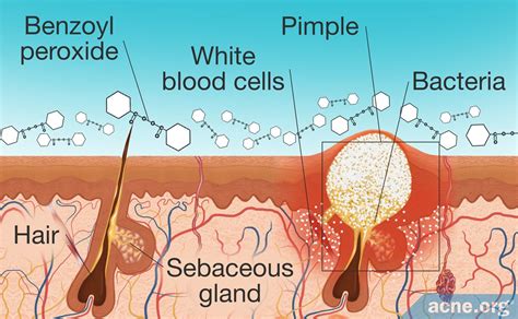 How Does Benzoyl Peroxide Work in the Skin? - Acne.org