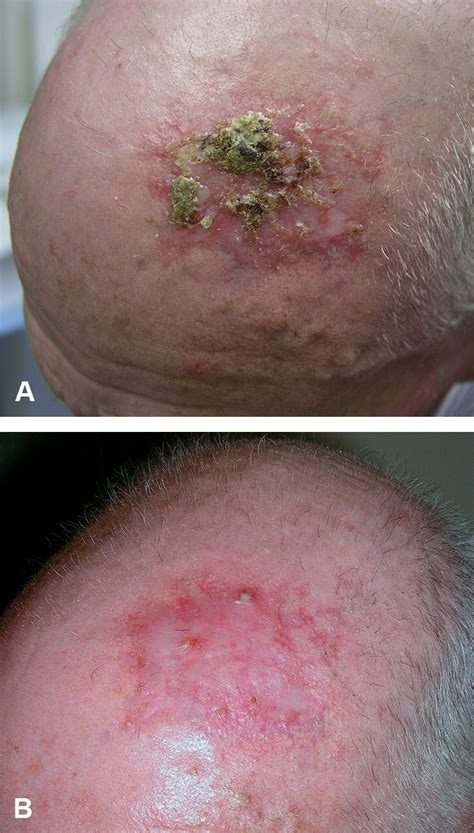 Erosive pustular dermatosis of the scalp and nonscalp - Journal of the American Academy of ...