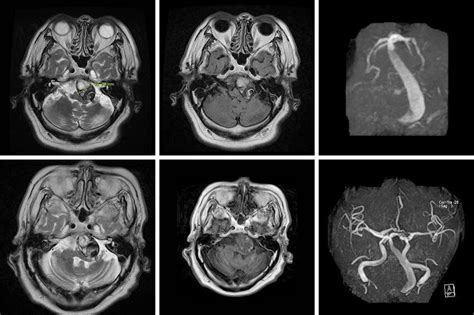 (A, B) Magnetic resonance imaging (MRI) showing a giant vertebrobasilar... | Download Scientific ...