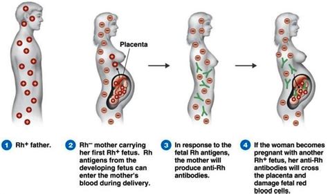 Rh Incompatibility - Complications, Causes, Symptoms, Dx, Rx