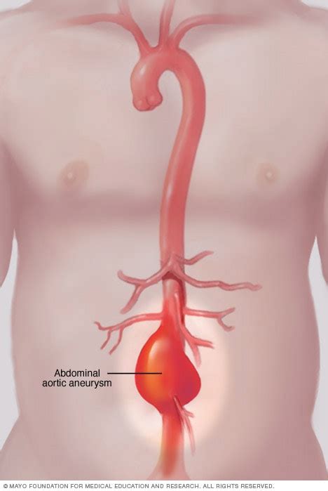 Abdominal aortic aneurysm - Symptoms and causes - Mayo Clinic