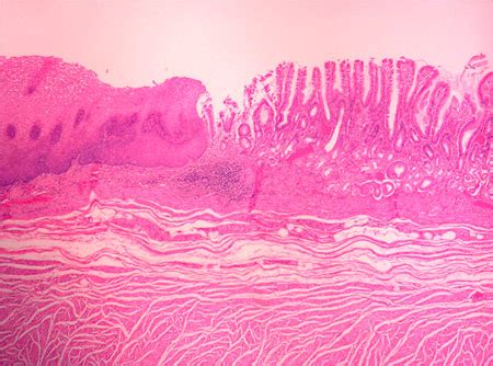 Esophagus/stomach junction