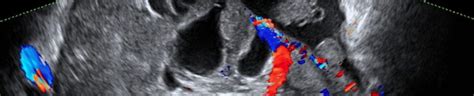 Common Adnexal Masses - GynaecologyUltrasound.com