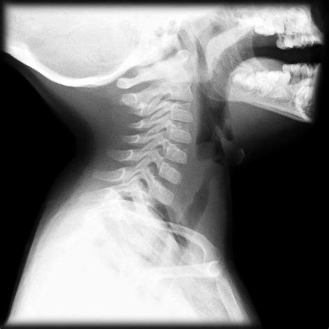 Bacterial Tracheitis - Respiratory - Medbullets Step 1