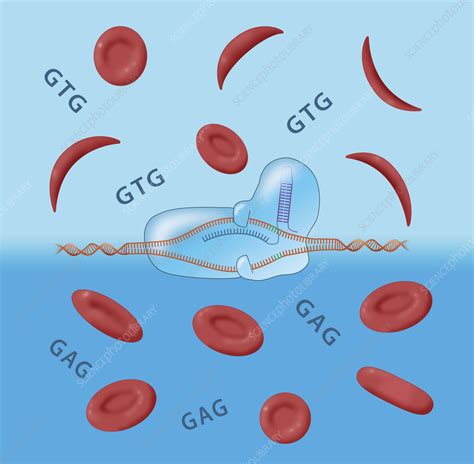 CRISPR sickle cell disease treatment, conceptual illustration - Stock ...