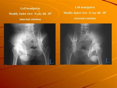 The modification plain radiographic of pelvis