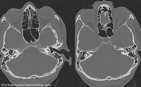 Dr Balaji Anvekar FRCR: Temporal Bone Fracture with Facial Nerve Palsy