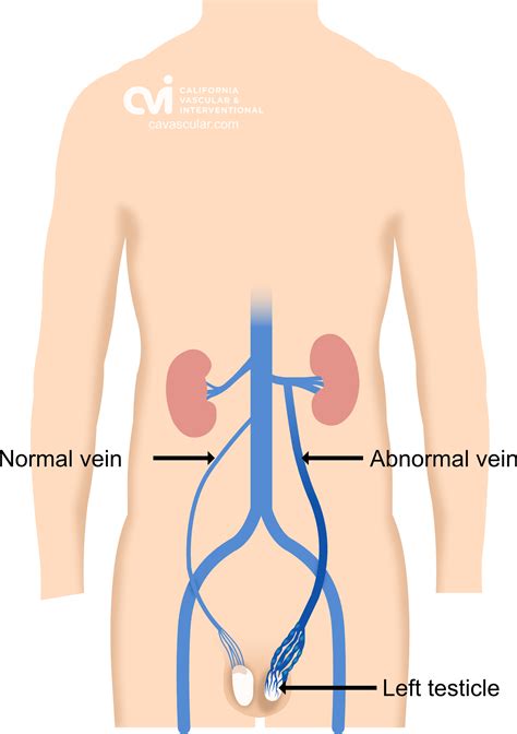 Gonadal Vein Anatomy