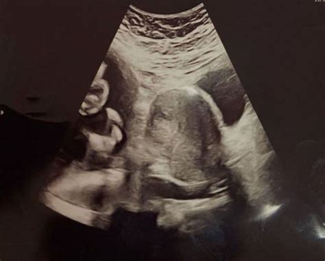 Didelphys Uterus Ultrasound