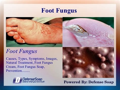 Foot Fungus in Athletes