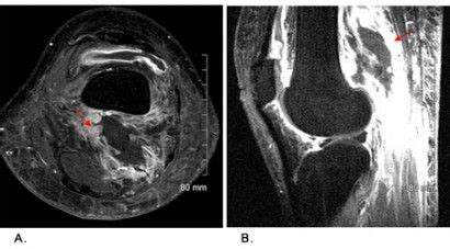 Diabetic Myonecrosis Presenting with Bilateral Knee Effusion