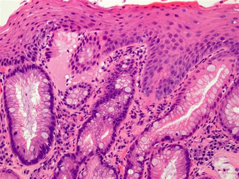 Barretts Esophagus Histology