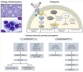 Burkitt's Lymphoma: Stages, Symptoms, Diagnosis, Treatment, Prognosis ...