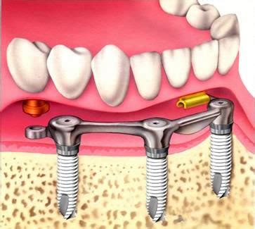 WizDent: DENTAL IMPLANTS PART I