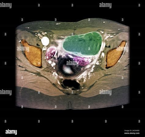 Ovarian cyst. X-ray of a section through the pelvic region of a 29-year-old woman (front of the ...