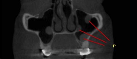 A coronal image showing polyps (P) in the maxillary sinuses. | Download ...