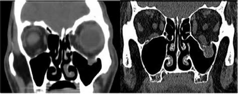 Coronal CT views of left orbital blow-out fracture Traditionally ...