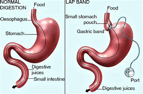 What is Lap Band Surgery & its Side Effects? | Better Weigh Center