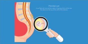 Living With Pilonidal Sinus- Things To Take Care Of - Pristyn Care