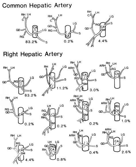 Image of variations in origin of common hepatic artery and variations in origin of right hepatic ...