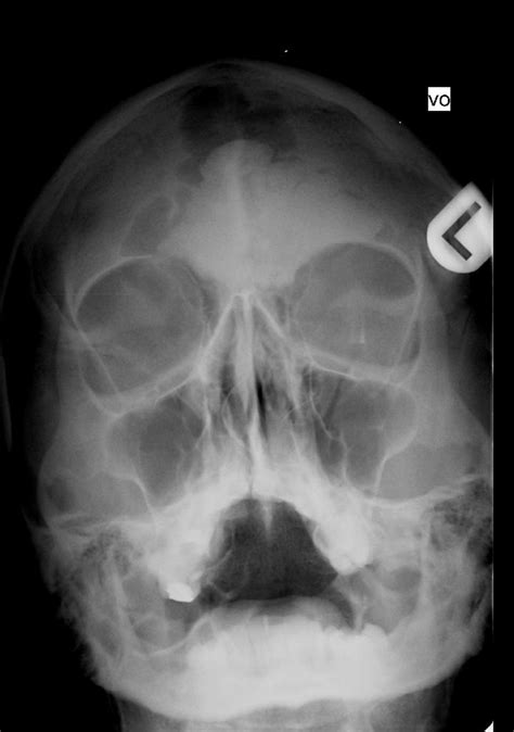 Frontal Sinus X Ray