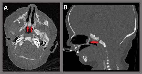 Cureus | Surgical Management of Choanal Atresia: Two Classic Cases and ...