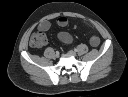 Epiploic appendagitis | Radiology Case | Radiopaedia.org