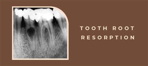 Tooth Root Resorption - Symptoms, Causes, Treatment - Clove Dental