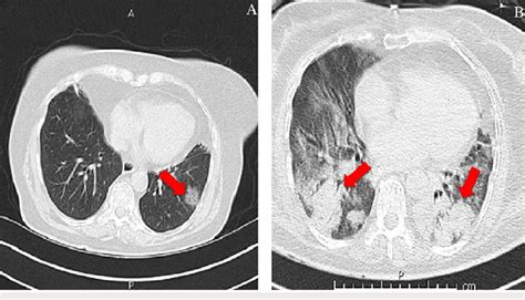 Chest CT scan of a 66-year-old female patient. A. Third chest CT image ...