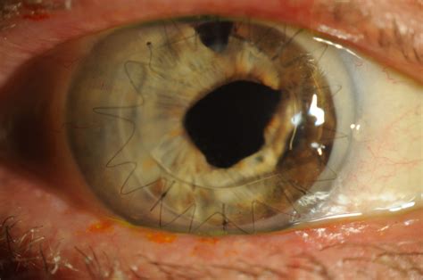 Abiotrophia defectiva causing infectious crystalline keratopathy and corneal ulcer after ...