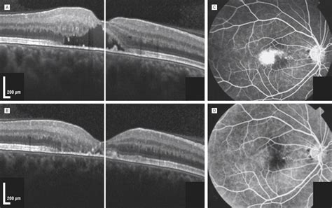 Intravitreous Ranibizumab as Treatment for Macular Telangiectasia Type 2 | Dermatology | JAMA ...