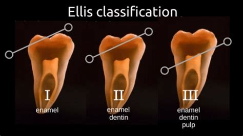 Ellis classification for tooth fracture | News | Dentagama