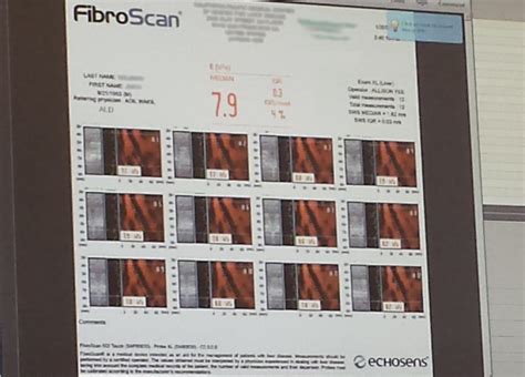 Healing Liver Cirrhosis: My Husband's Fibroscan Results are IN... and ...