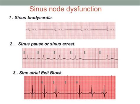 sinus arrest vs sinus block - Google Search