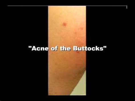 Acne of the Buttocks - YouTube